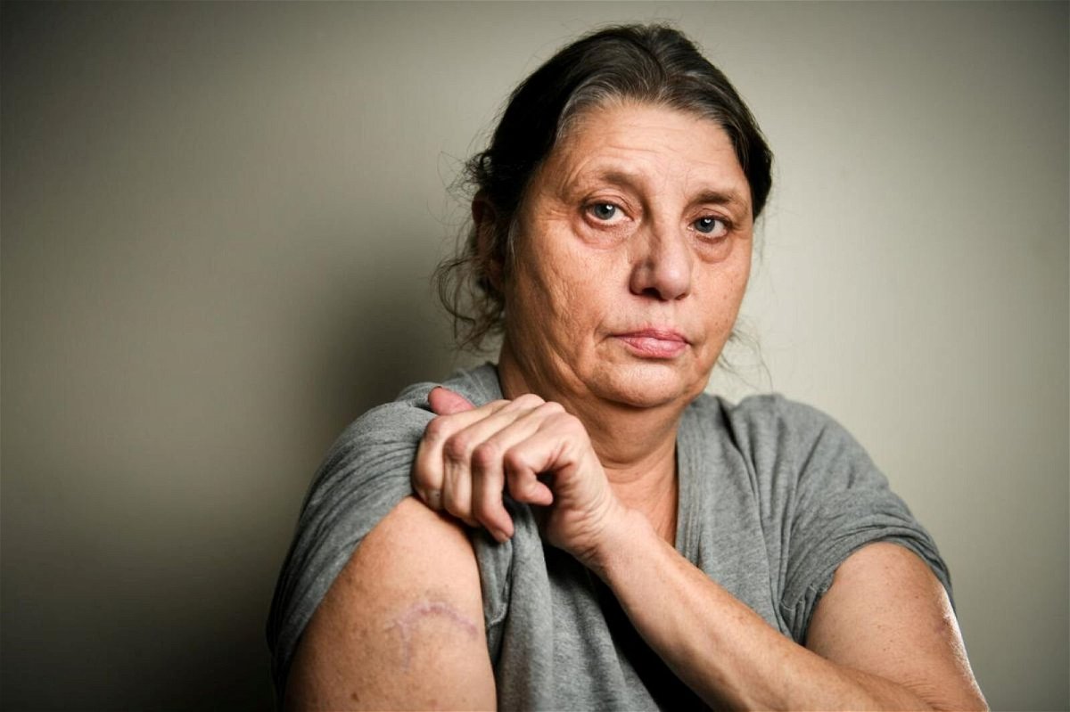 <i>Meg McLaughlin/Quad City Times</i><br/>Shannon Songer pulls up her sleeve to show the scar on her arm she got from being stabbed by her boyfriend in Davenport.
