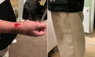 Photos of Anthony Romero's injury as well as of the alleged shoeprints that were provided by his attorney.