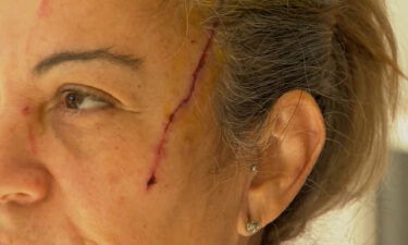 The woman received scratches on her face from the attack.