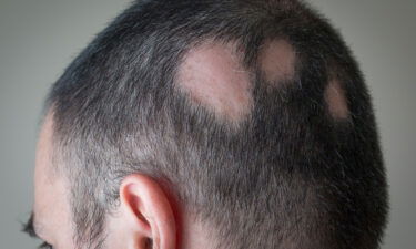 Alopecia areata begins with one or more small bald patches