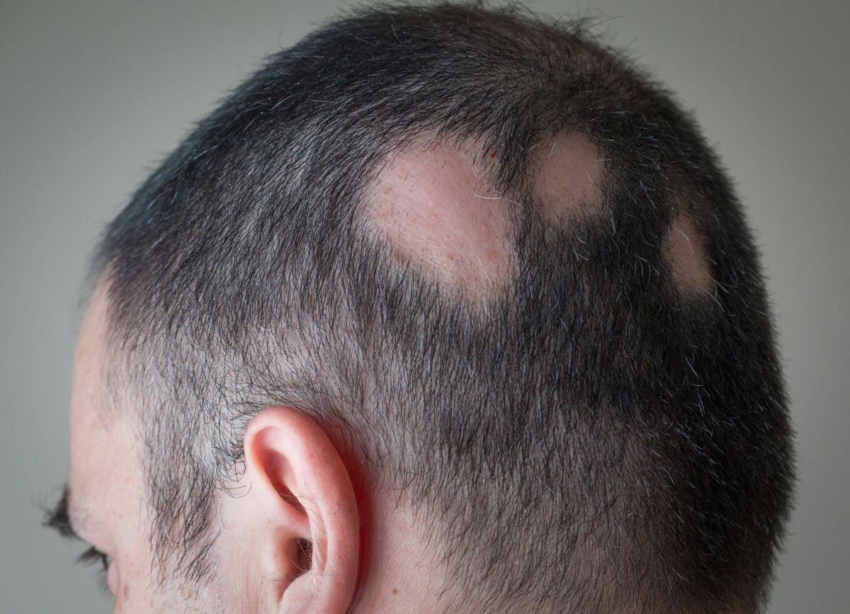 <i>Alex Papp/Adobe Stock</i><br/>Alopecia areata begins with one or more small bald patches
