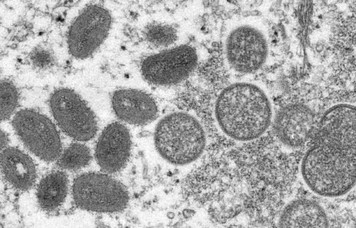 The United States is responding to a request for the release of monkeypox vaccine from the nation's Strategic National Stockpile as a global outbreak of cases is under investigation.
