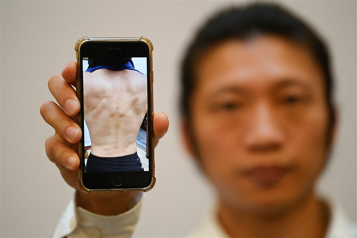 <i>Toby Melville/Reuters</i><br/>Hong Kong protester Bob Chan shows a photograph of his injuries at a news conference in London on October 19.