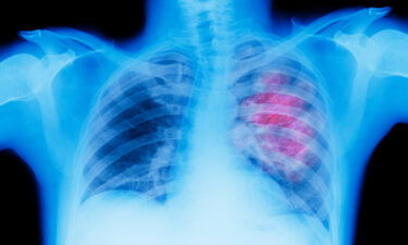 Illustration of an X-ray depicting lung cancer