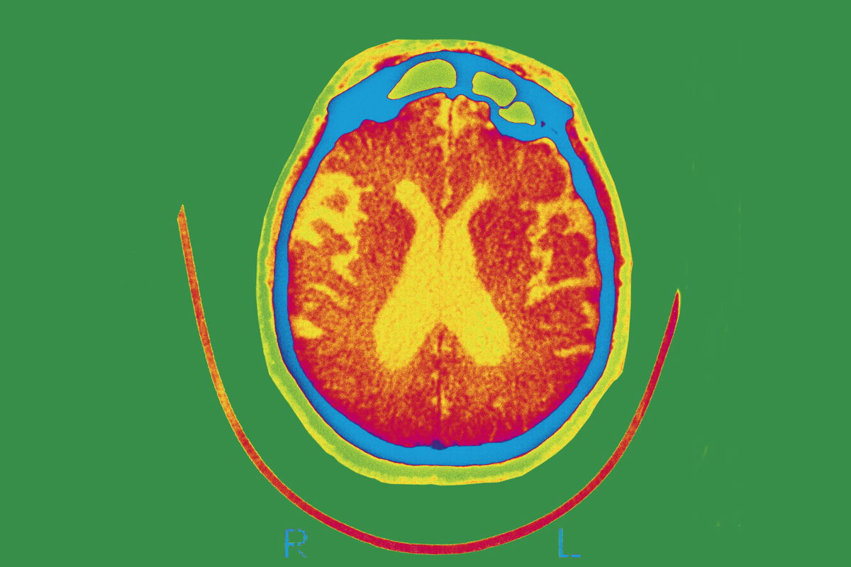 <i>BSIP/UIG/Getty Images</i><br/>Seen here is a scan of the brain of a patient affected by Alzheimer's disease. An experimental therapy