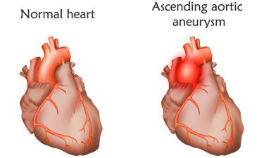 An aortic aneurysm is a bulge in the aorta