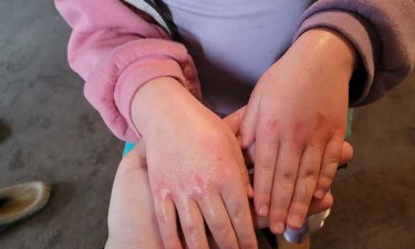 Ayla Antoniazzi's 4-year-old daughter developed a rash after going back to school in East Palestine.