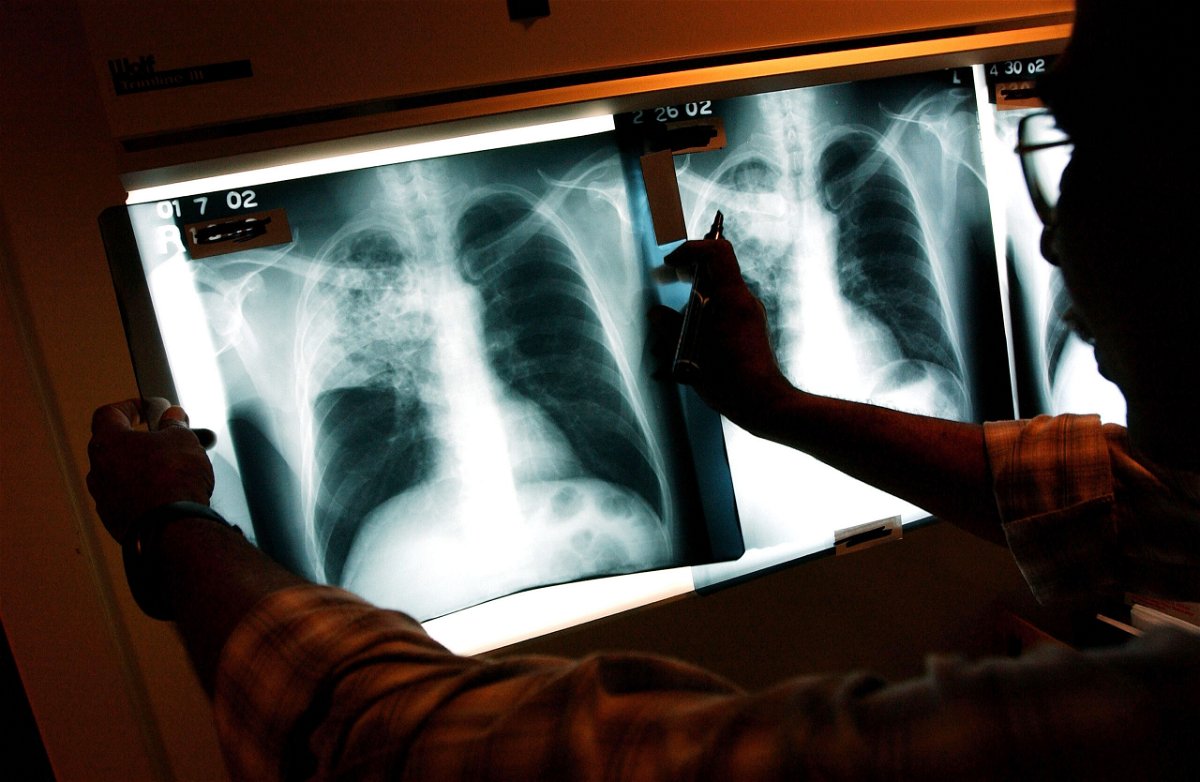 <i>Spencer Platt/Getty Images/File</i><br/>Many tuberculosis diagnoses may have been missed