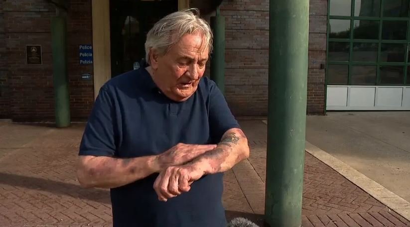 <i>WLOS via CNN Newsource</i><br/>Bob Campbell shows bruises on his arms. He along with two others say they were attacked and beaten during a Palestinian Resistance event held at the West Asheville Library.